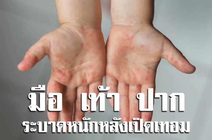 มือ เท้า ปาก ระบาดหนักหลังเปิดเทอม